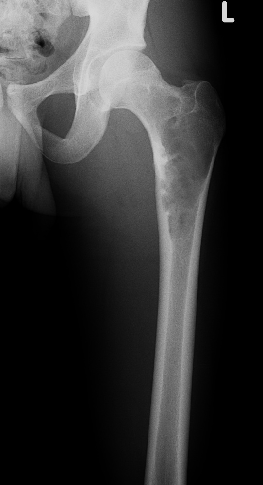 Bone Tumours And Benign Lytic Lesions